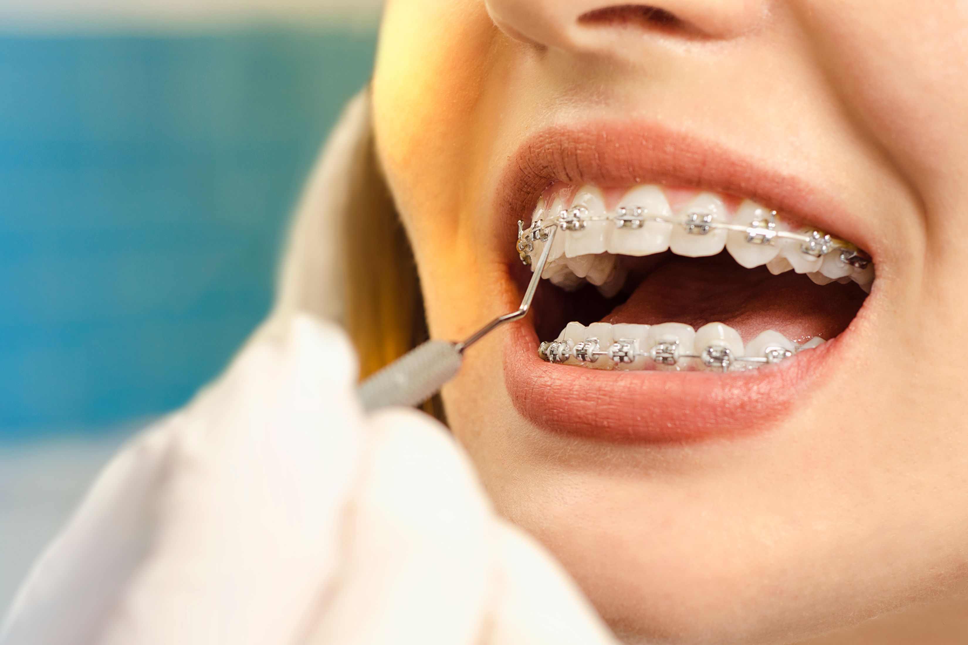 braces treatment