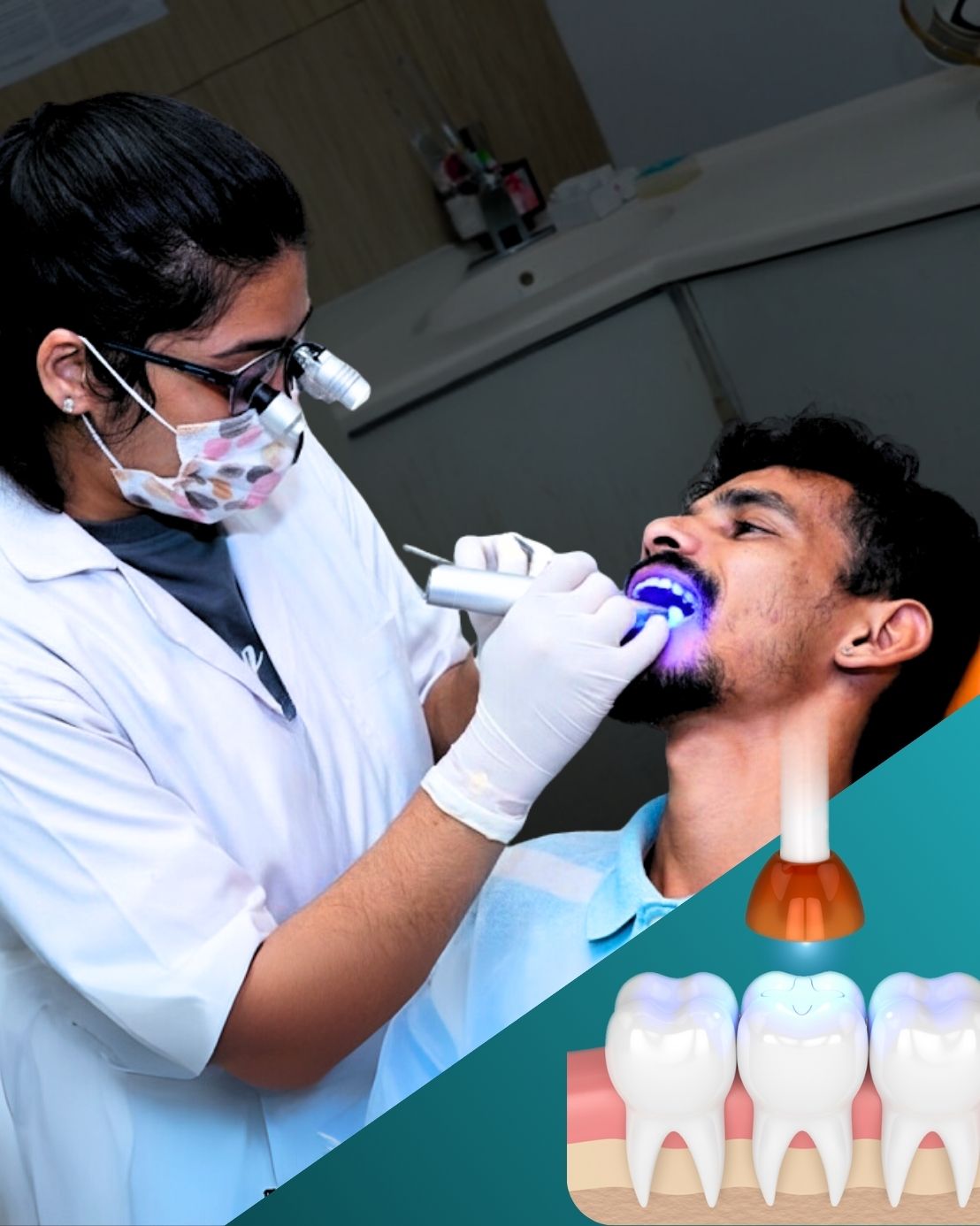 dental filling