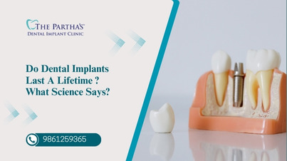  do dental implants last a lifetime-what science says