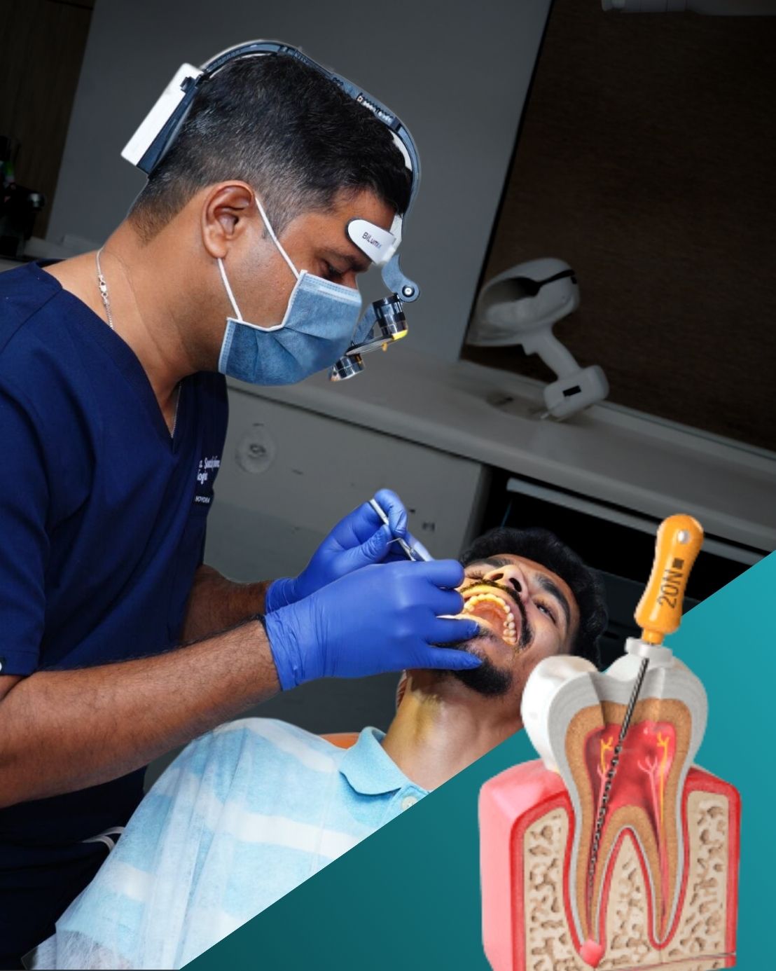root canal treatment