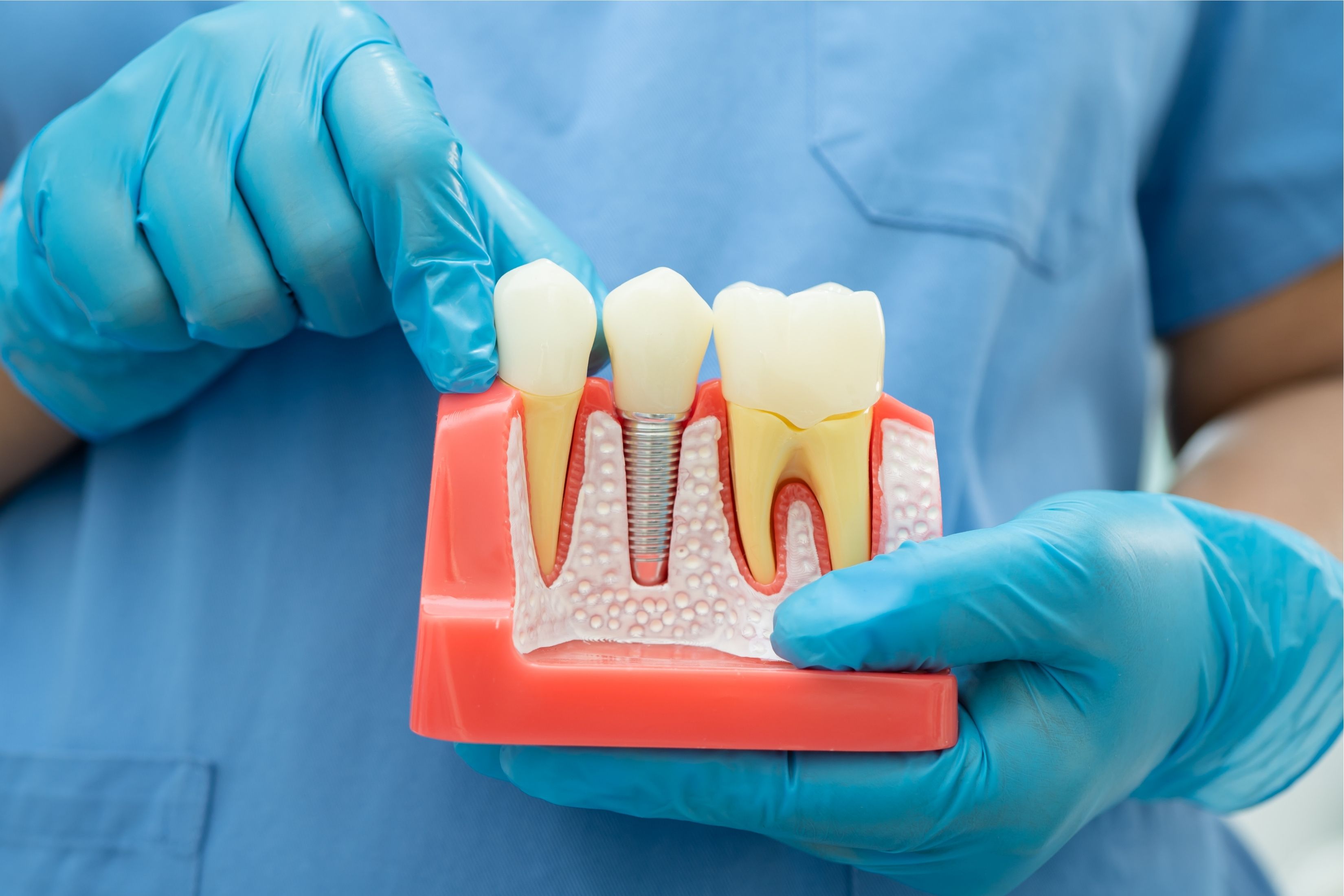 single tooth implants